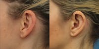 Dr. Francis Otoplasty Before & After Gallery - Patient 148702888 - Image 1