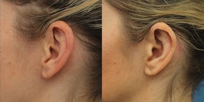 Dr. Francis Otoplasty Before & After Gallery - Patient 148702888 - Image 1