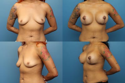 Dr. Francis Breast Lift with Implants Before & After Gallery - Patient 155952861 - Image 1