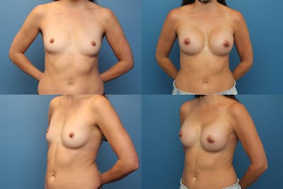 Dr. Francis Breast Augmentation Before & After Gallery - Patient 155952808 - Image 1