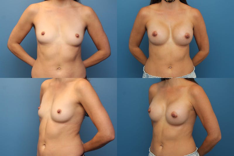 Dr. Francis Breast Augmentation Before & After Gallery - Patient 155952808 - Image 1