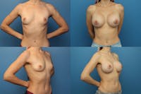 Dr. Francis Breast Augmentation Before & After Gallery - Patient 155952809 - Image 1