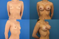 Dr. Francis Breast Augmentation Before & After Gallery - Patient 155952810 - Image 1