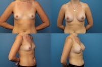 Dr. Francis Breast Augmentation Before & After Gallery - Patient 155952811 - Image 1