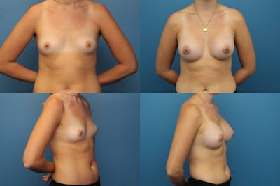 Dr. Francis Breast Augmentation Before & After Gallery - Patient 155952811 - Image 1