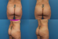 Dr. Francis Brazilian Butt Lift Before & After Gallery - Patient 155732178 - Image 1