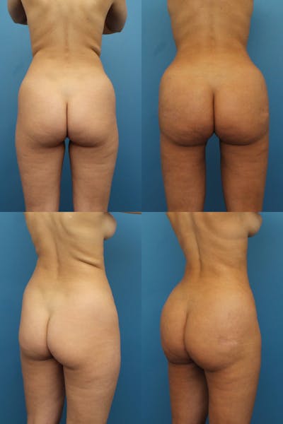 Dr. Francis Brazilian Butt Lift Before & After Gallery - Patient 155732176 - Image 1