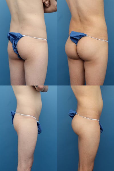 Dr. Francis Buttock Augmentation with Implants Before & After