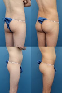 Dr. Francis Buttock Augmentation with Implants Before & After Gallery - Patient 149236062 - Image 1