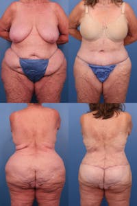 Body Lift / Thigh Lift Before & After Gallery - Patient 153081063 - Image 1