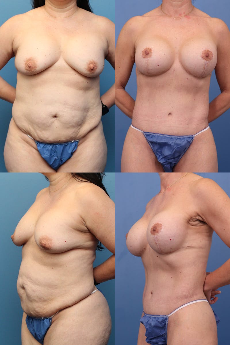 Mommy Makeover Before & After Gallery - Patient 154776692 - Image 1
