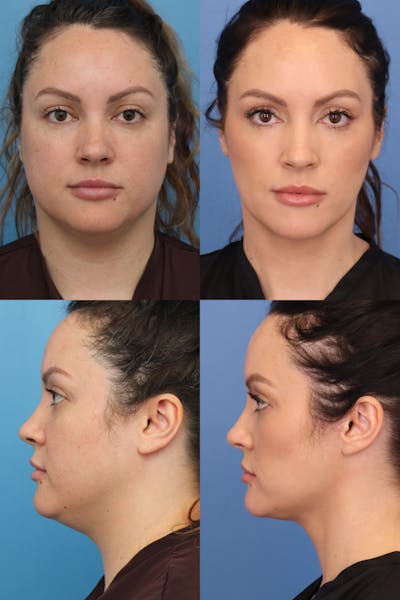 Neck Liposuction Before & After Gallery - Patient 154776776 - Image 1