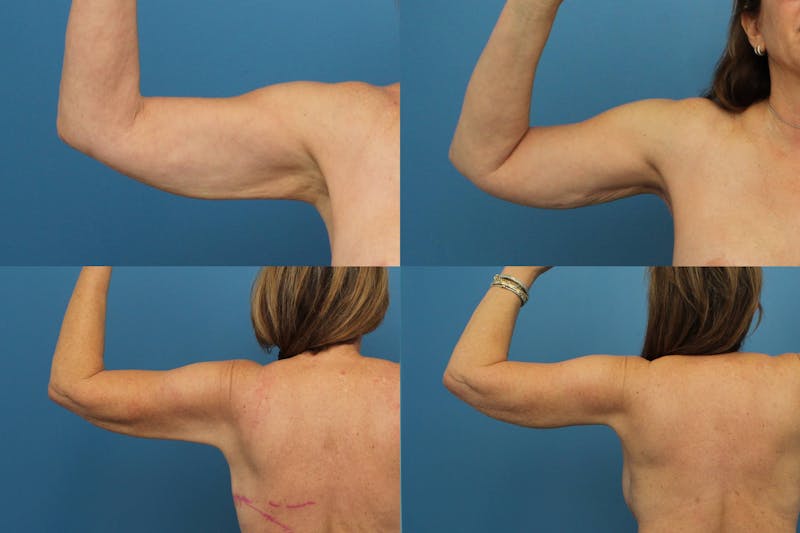 Dr. Francis Arm Lift Before & After Gallery - Patient 155732182 - Image 1