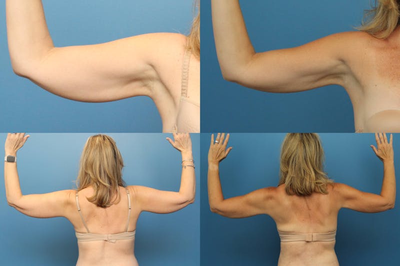 Dr. Francis Arm Liposuction Before & After Gallery - Patient 155732218 - Image 1