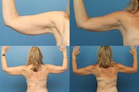 Dr. Francis Arm Liposuction Before & After Gallery - Patient 155732218 - Image 1