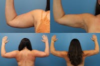 Dr. Francis Arm Liposuction Before & After Gallery - Patient 155732219 - Image 1
