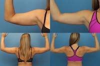 Dr. Francis Arm Liposuction Before & After Gallery - Patient 155732220 - Image 1