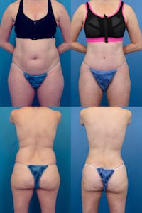 Dr. Francis Tummy Tuck Before & After Gallery - Patient 155732253 - Image 1