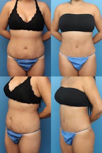Dr. Francis Tummy Tuck Before & After Gallery - Patient 155732255 - Image 1