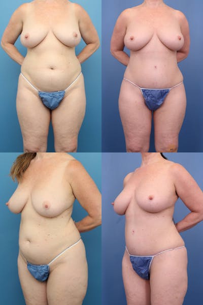 Dr. Francis Tummy Tuck Before & After Gallery - Patient 155732257 - Image 1