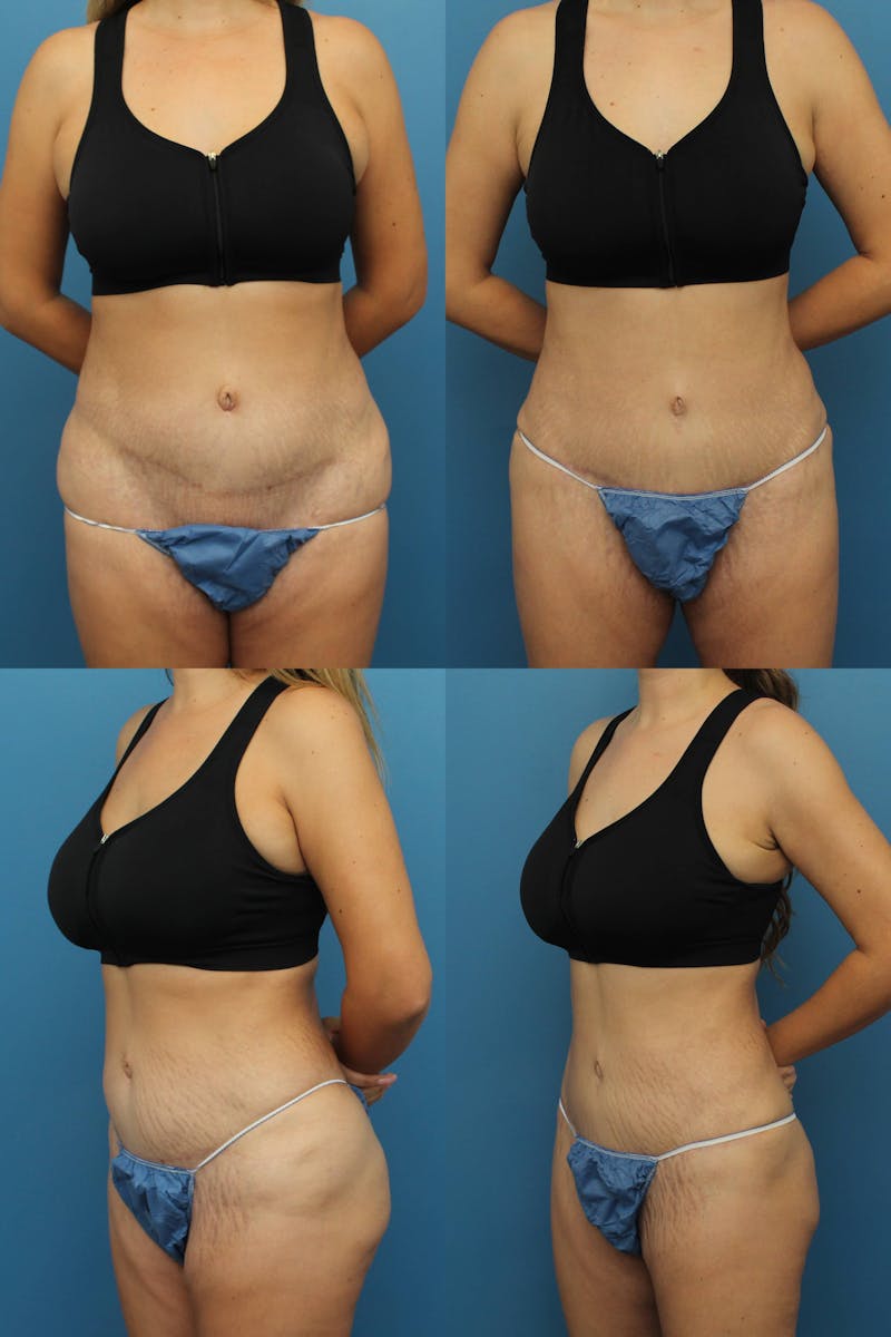 Dr. Francis Tummy Tuck Before & After Gallery - Patient 155732259 - Image 1