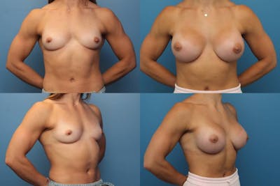 Dr. Francis Body Building Figure and Frames Before & After Gallery - Patient 155732325 - Image 1