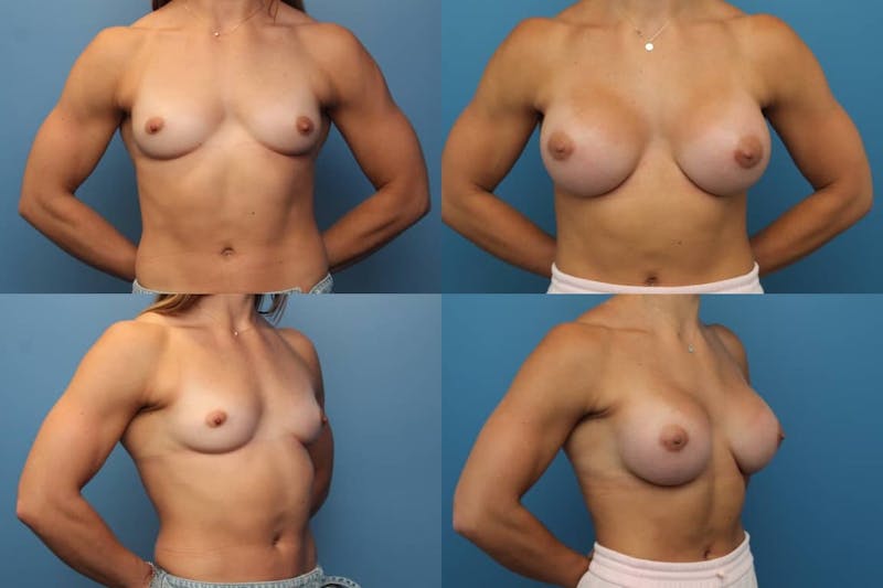 Dr. Francis Breast Augmentation Before & After Gallery - Patient 155952815 - Image 1