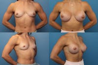 Dr. Francis Breast Augmentation Before & After Gallery - Patient 155952815 - Image 1