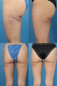 Dr. Francis Infragluteal Fat Grafting Before & After Gallery - Patient 155732350 - Image 1