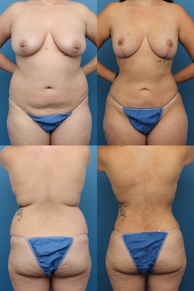 Dr. Francis Liposuction Before & After Gallery - Patient 155732414 - Image 1