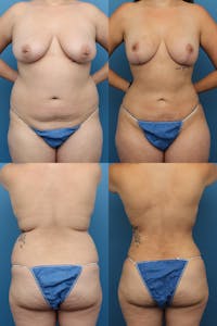 Dr. Francis Liposuction Before & After Gallery - Patient 155732414 - Image 1