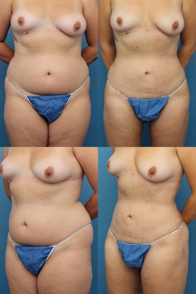 Dr. Francis Liposuction Before & After Gallery - Patient 155732415 - Image 1