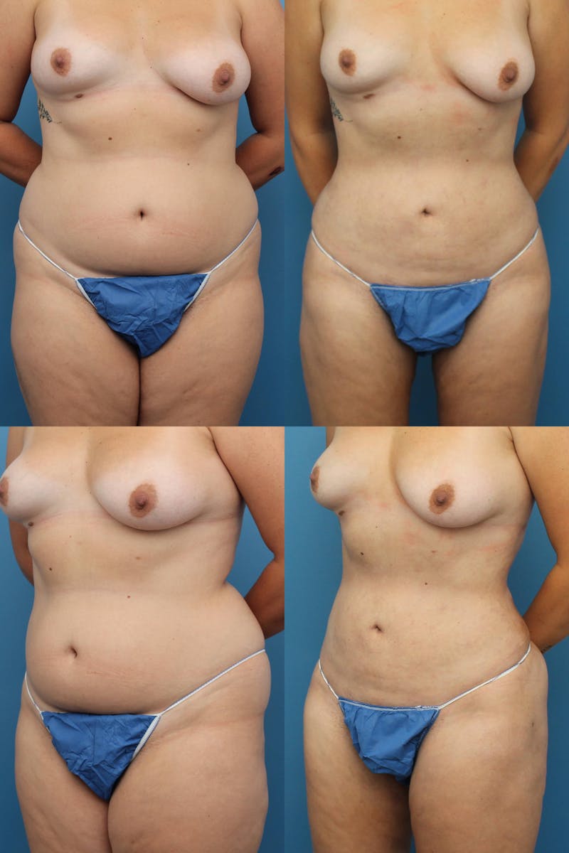 Dr. Francis Liposuction Before & After Gallery - Patient 155732415 - Image 1