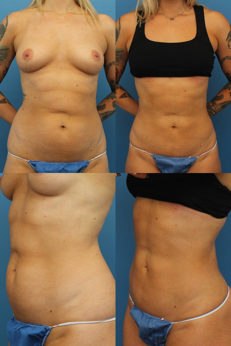Dr. Francis Liposuction Before & After Gallery - Patient 155732416 - Image 1