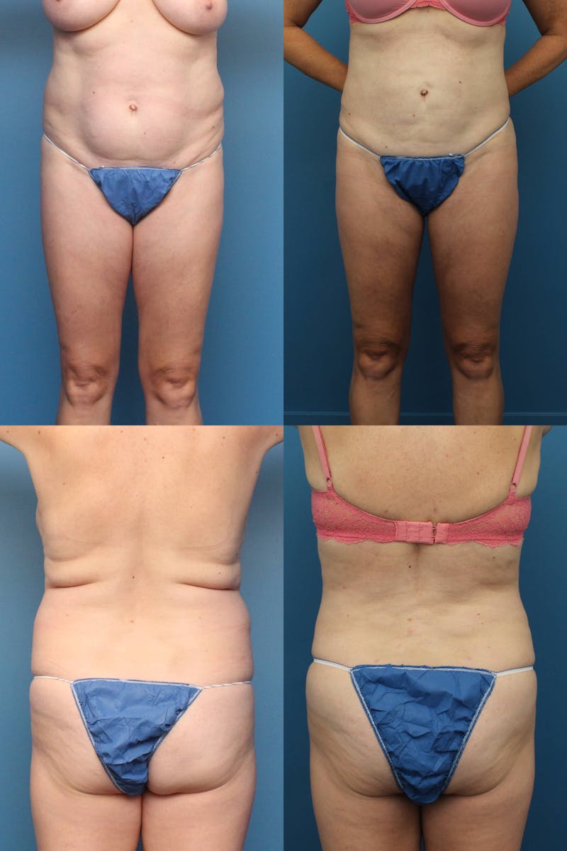 Dr. Francis Liposuction Before & After Gallery - Patient 155732417 - Image 1