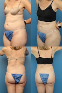 Dr. Francis Liposuction Before & After Gallery - Patient 155732418 - Image 1