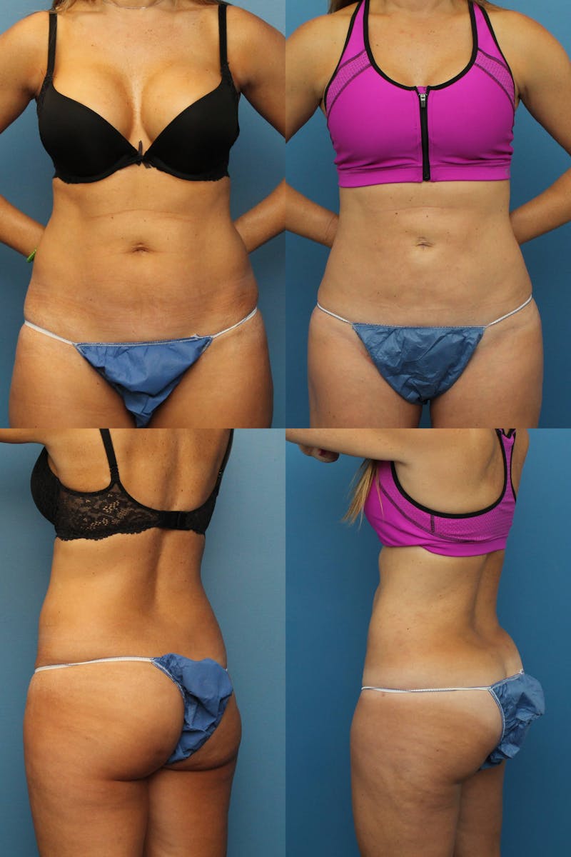 Dr. Francis Liposuction Before & After Gallery - Patient 155732419 - Image 1