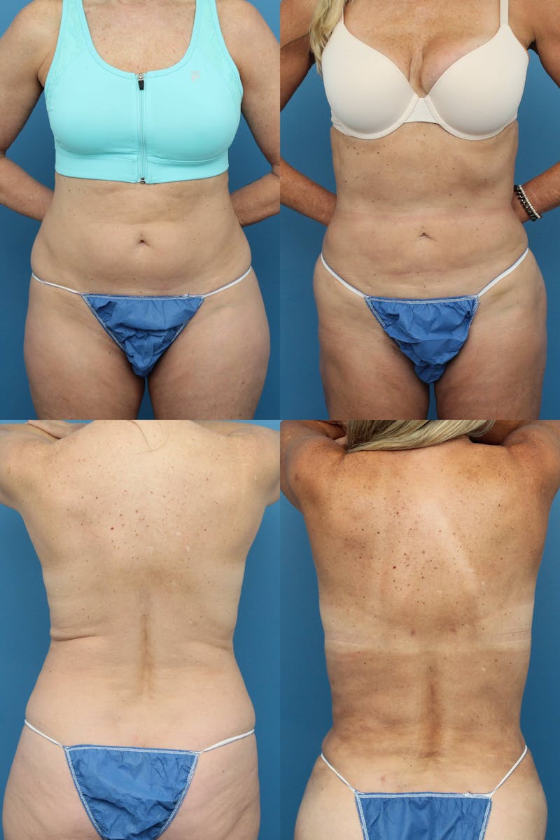 Dr. Francis Liposuction Before & After Gallery - Patient 155732422 - Image 1