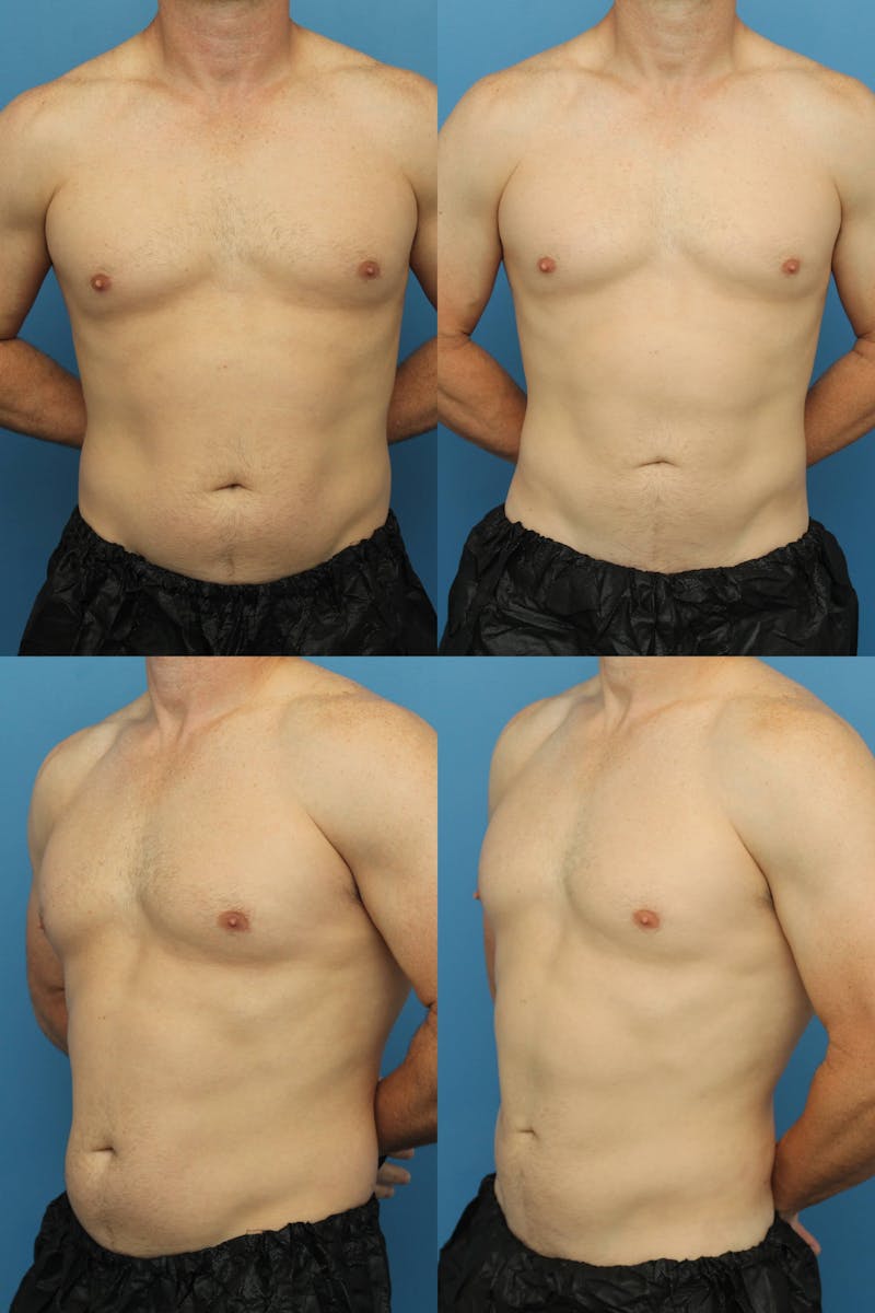 Dr. Francis Liposuction Before & After Gallery - Patient 155732423 - Image 1