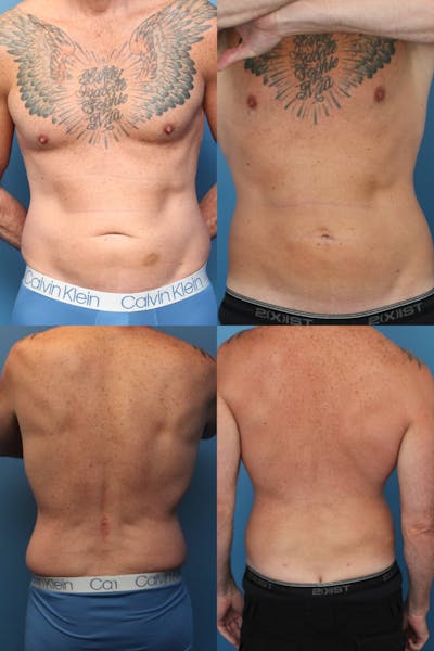 Dr. Francis Liposuction Before & After Gallery - Patient 155732424 - Image 1