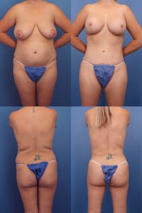 Dr. Francis Mommy Makeover Before & After Gallery - Patient 155732484 - Image 1