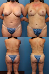 Dr. Francis Mommy Makeover Before & After Gallery - Patient 155732487 - Image 1