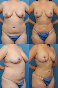Dr. Francis Mommy Makeover Before & After Gallery - Patient 155732488 - Image 1
