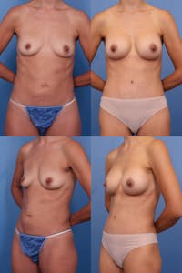 Dr. Francis Mommy Makeover Before & After Gallery - Patient 155732489 - Image 1