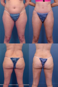 Dr. Francis Thigh Liposuction Before & After Gallery - Patient 155732528 - Image 1