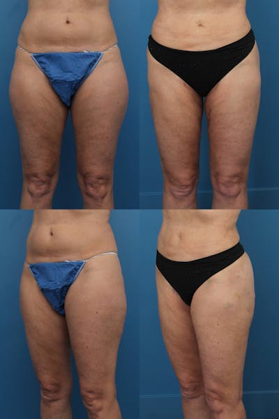 Dr. Francis Thigh Liposuction Before & After Gallery - Patient 155732529 - Image 1