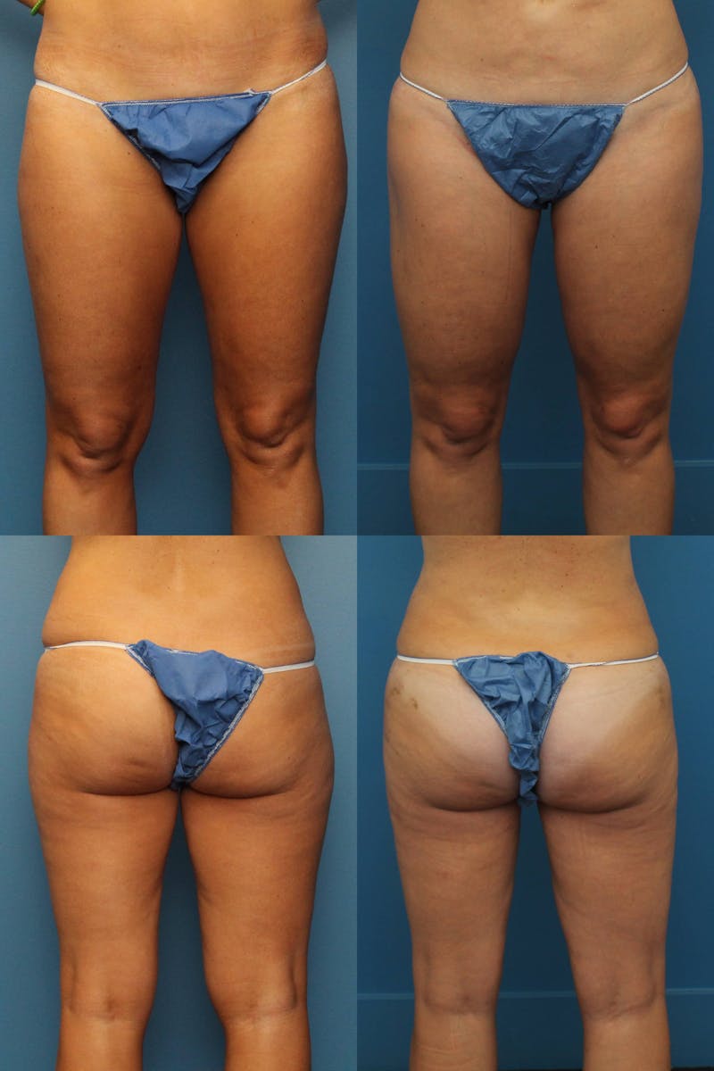 Dr. Francis Thigh Liposuction Before & After Gallery - Patient 155732530 - Image 1