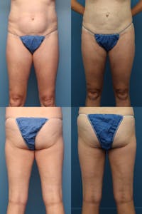 Dr. Francis Thigh Liposuction Before & After Gallery - Patient 155732531 - Image 1