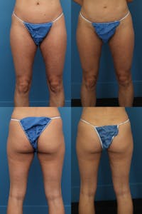 Dr. Francis Thigh Liposuction Before & After Gallery - Patient 155732532 - Image 1