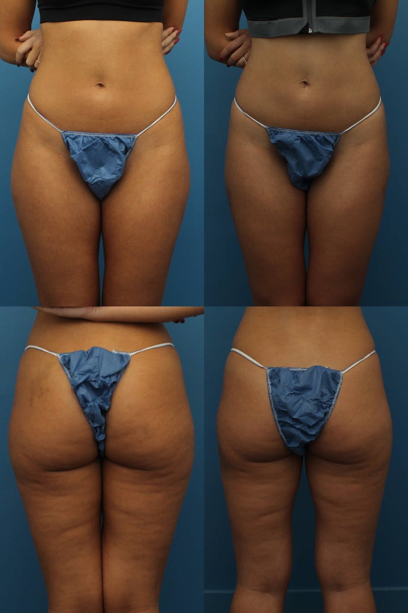 Dr. Francis Thigh Liposuction Before & After Gallery - Patient 155732533 - Image 1
